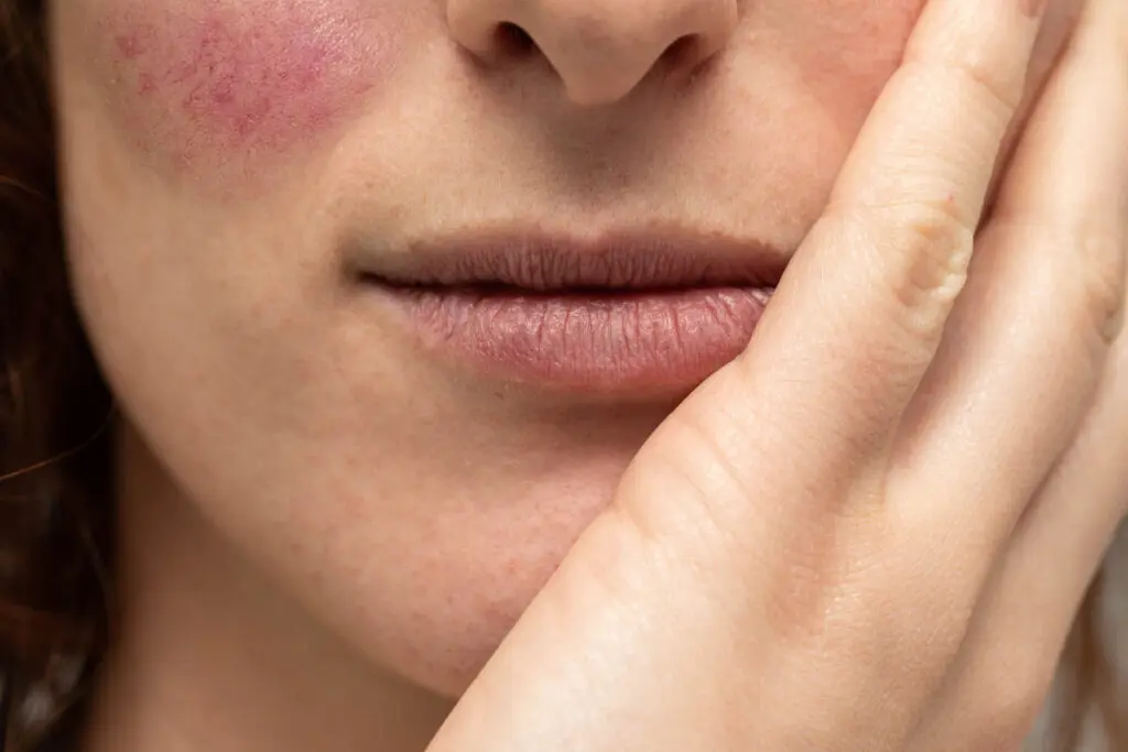 close up view caucasian woman resting her chin hand with visible cracked lips rosacea